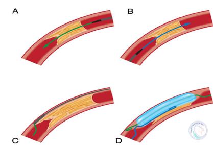 /img/news/full_timmachcanthiep_cto-pci-cai-thien-trieu-chung-va-chat-luong-cuoc-song-meta-analysis-eurocto-decision-cto-202641216444.jpeg